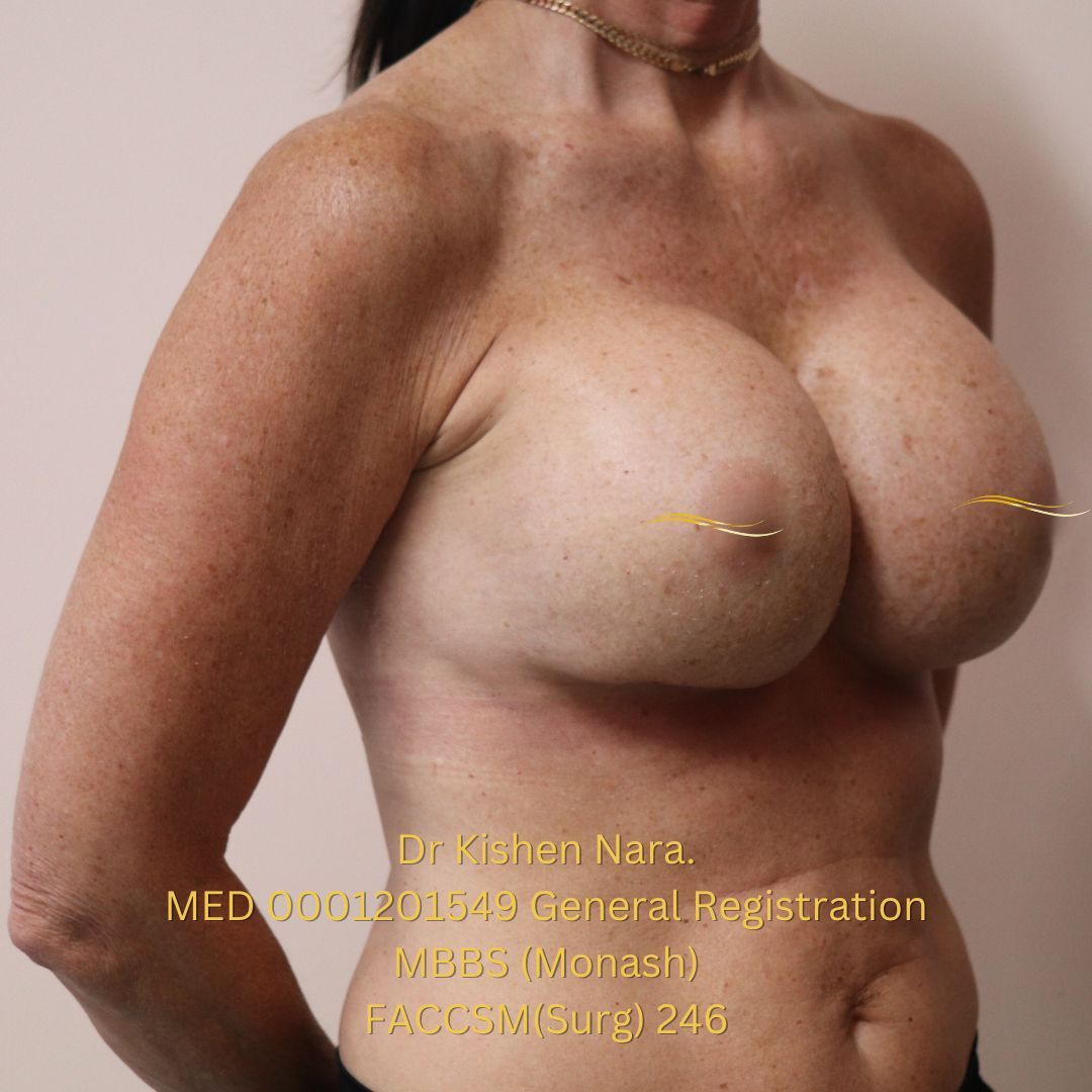 Revision breast implants — Left oblique view — after